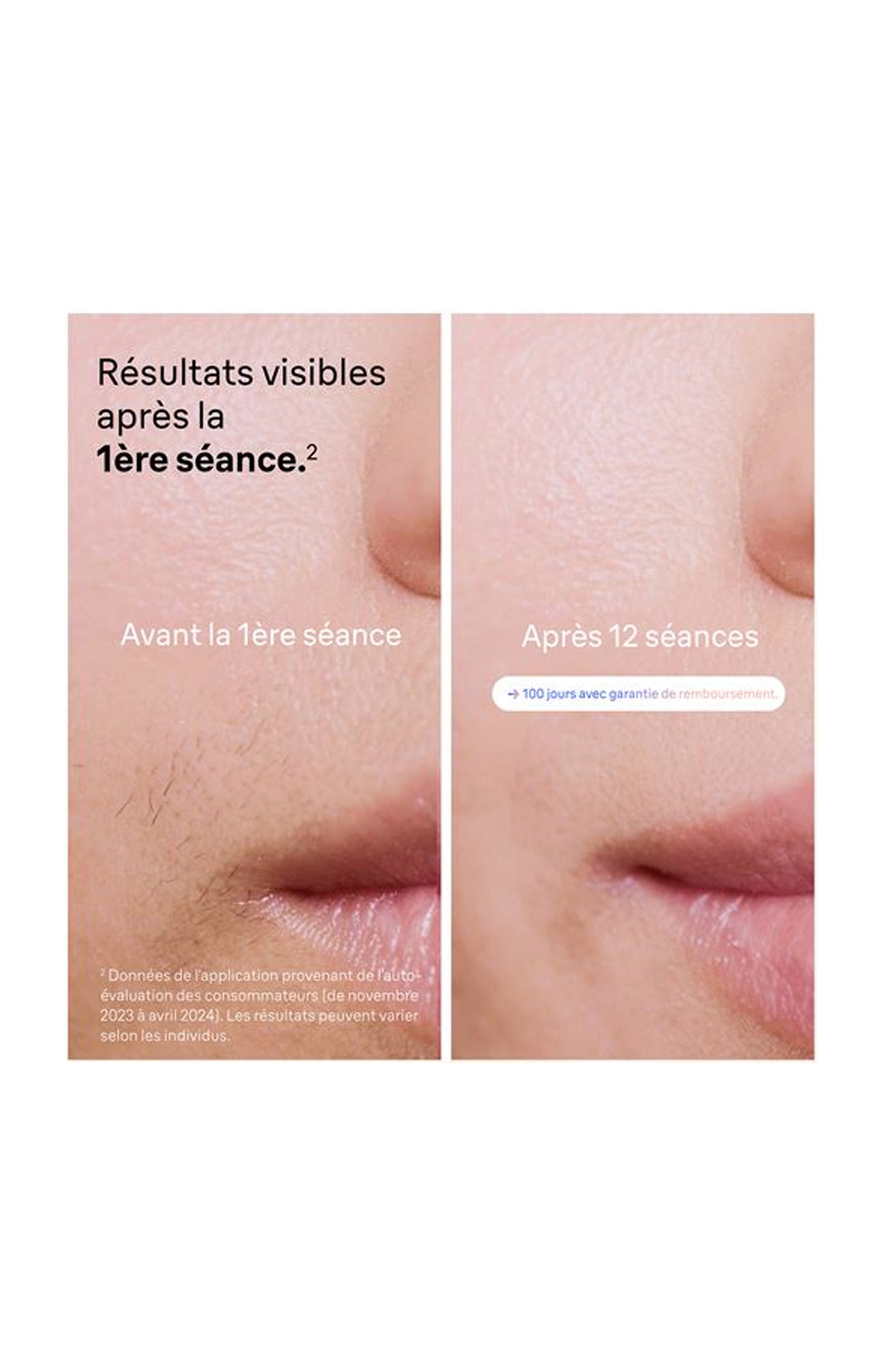 Épilateur lumière pulsée - Smart IPL 7 Skin i·expert PL7147 - Corps & visage