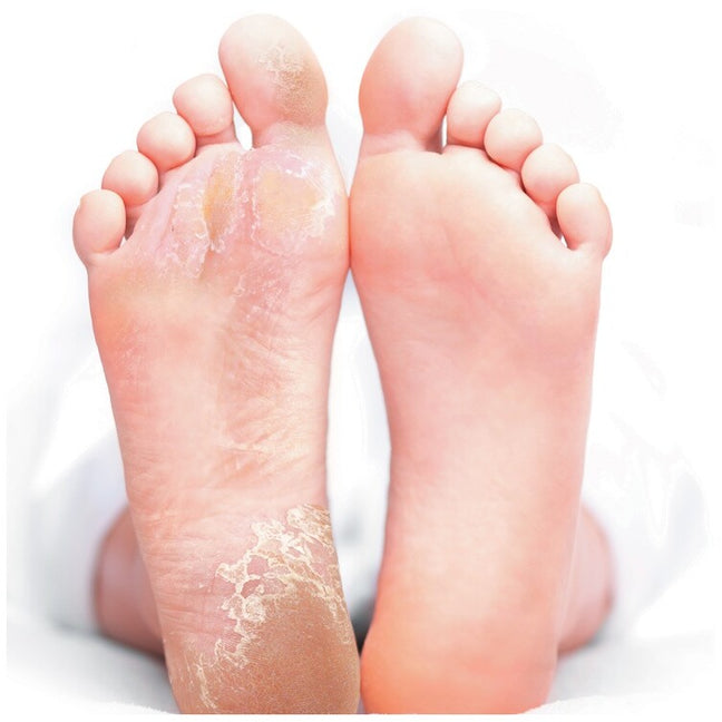 Masque-chaussette exfoliant - Pieds