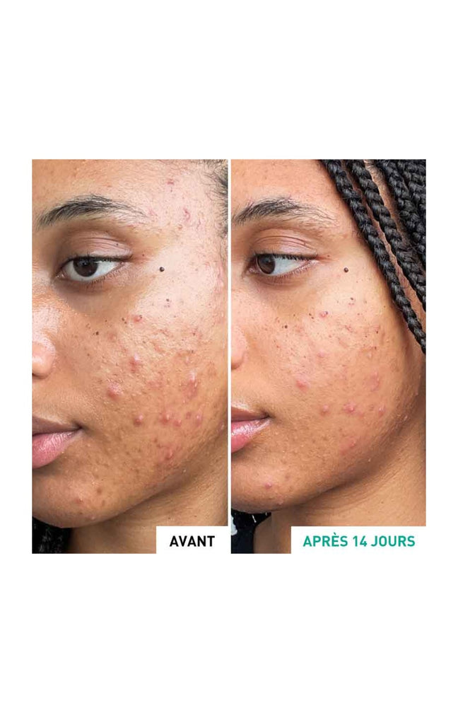 Soin anti-acné & anti-imperfections - Centella Acne Care - Niacinamide & rétinol végétal