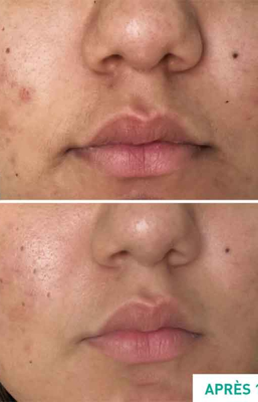 Soin anti-acné & anti-imperfections - Centella Acne Care - Niacinamide & rétinol végétal