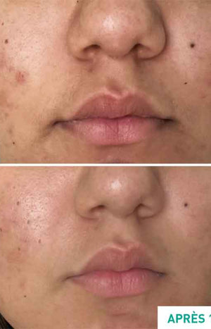 Soin anti-acné & anti-imperfections - Centella Acne Care - Niacinamide & rétinol végétal