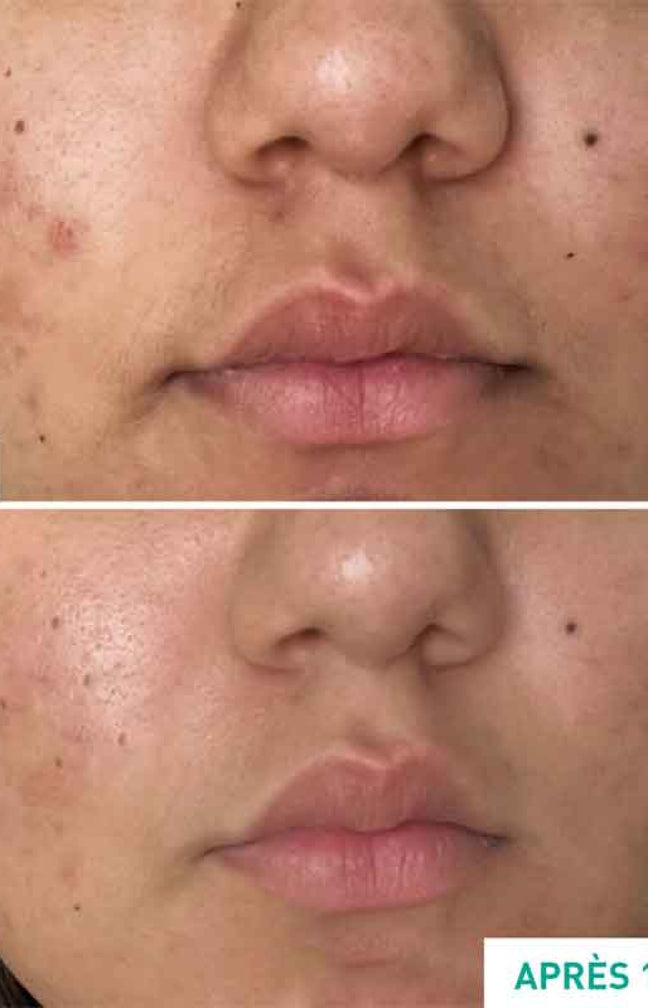Soin anti-acné & anti-imperfections - Centella Acne Care - Niacinamide & rétinol végétal