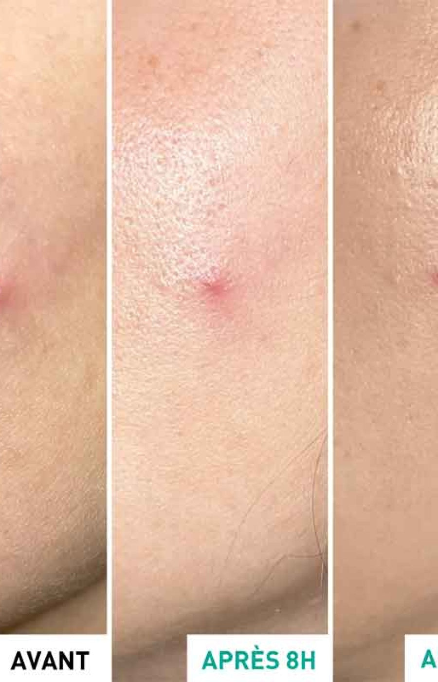 Gel effet patch anti-imperfections - Centella SOS Patch - Niacinamide & PHA - 9 ml