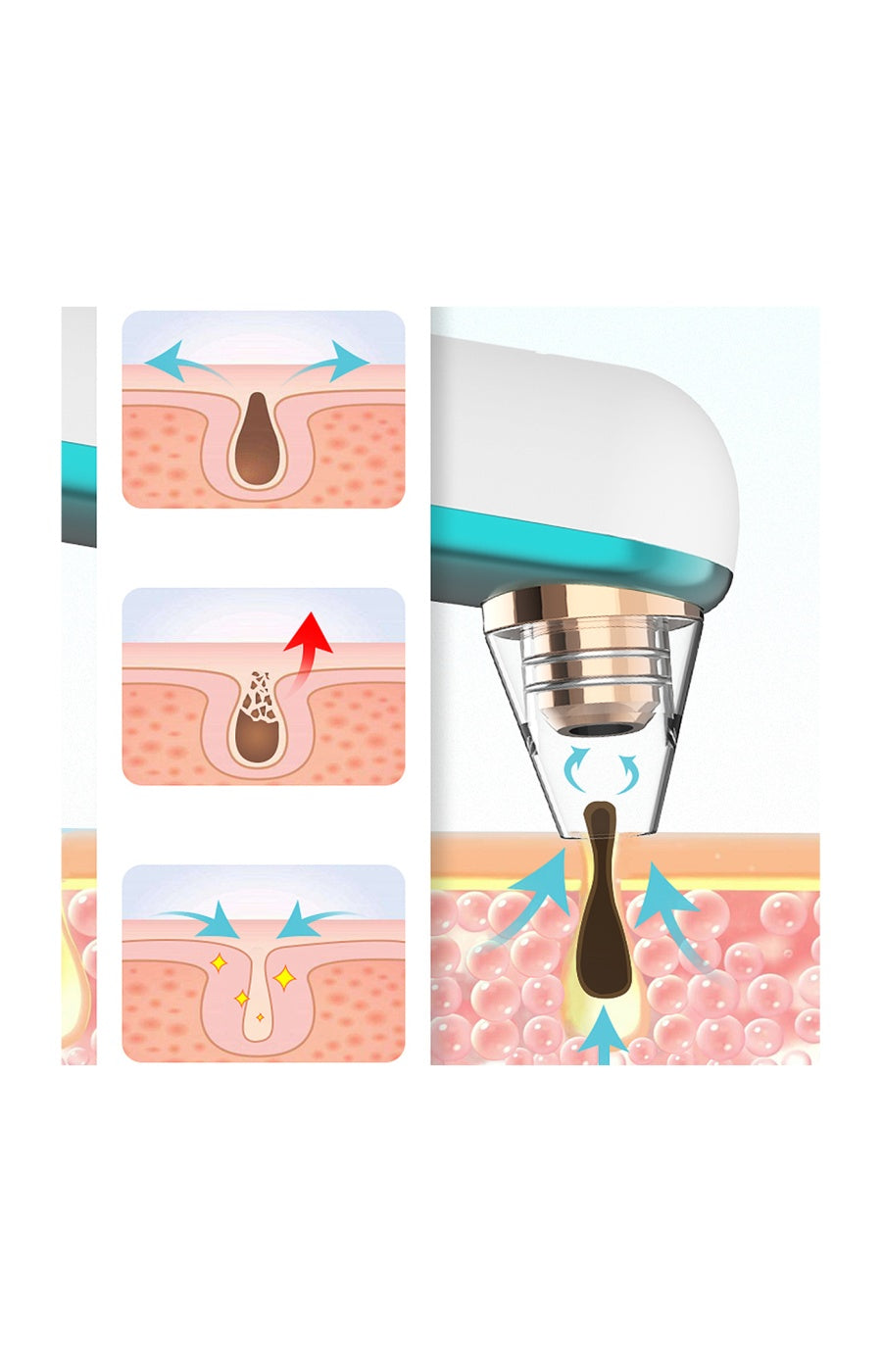 Extracteur de points noirs - Visage - Vert