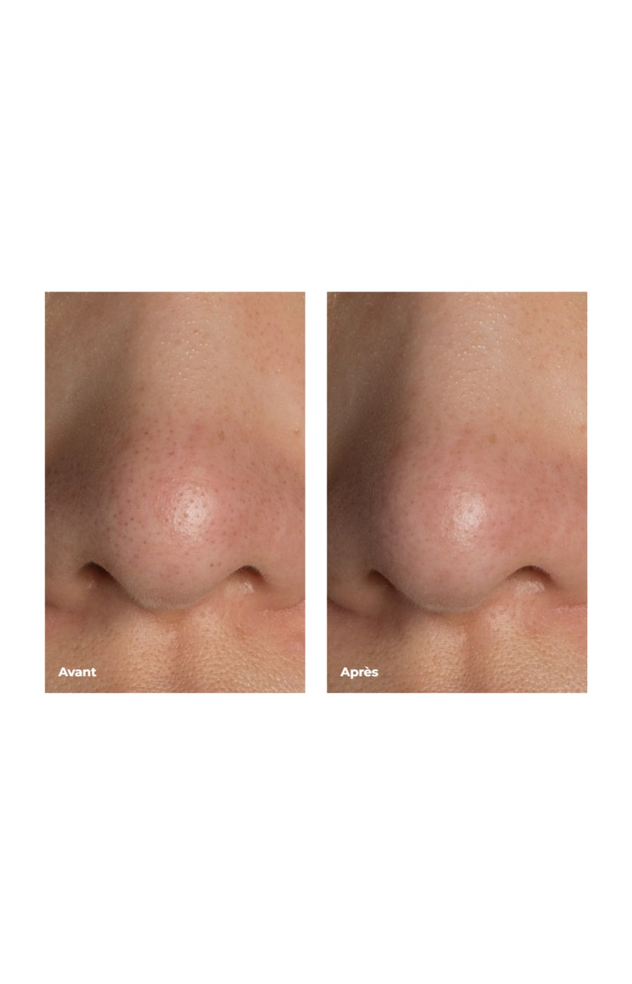 KIWI ™ - Aspirateur points noirs - Visage - Bleu