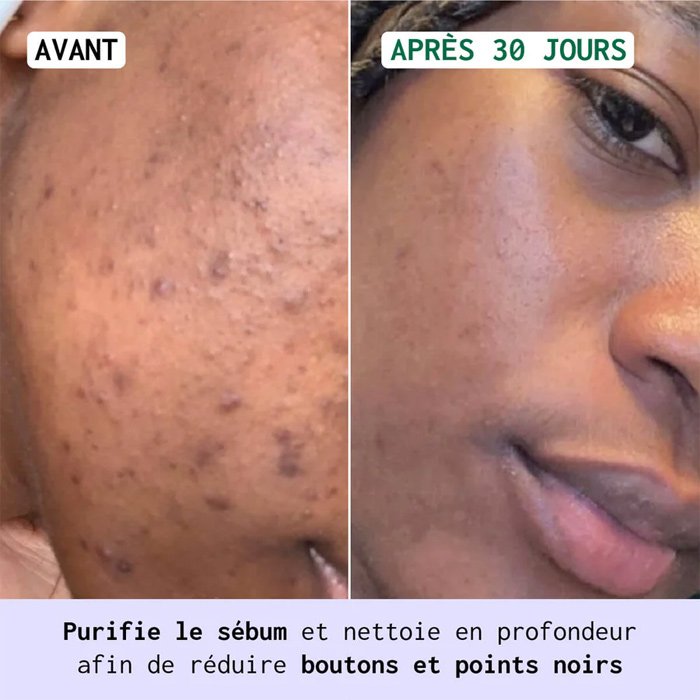 Gel nettoyant & soin anti-imperfections - Peaux grasses & acnéiques - 2 produits