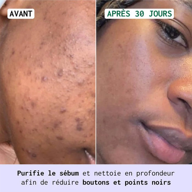 Gel nettoyant & soin anti-imperfections - Peaux grasses & acnéiques - 2 produits