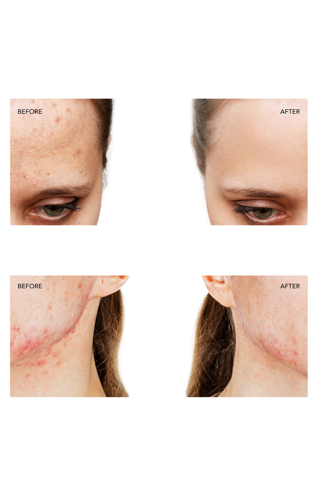 ESPADA 2 - Appareil anti-imperfections - Fuchsia - Visage