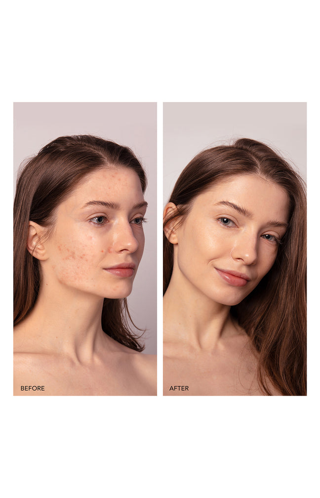 ESPADA™ 2 plus - Appareil anti-imperfections à lumière bleue - Visage - Lavender