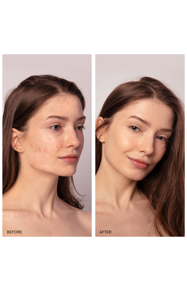 ESPADA™ 2 plus - Appareil anti-imperfections - Pistachio - Visage