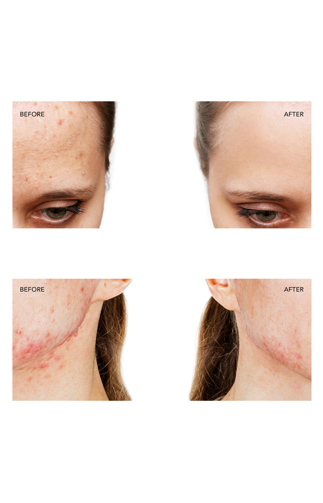 ESPADA 2 - Appareil anti-imperfections - Pearl pink - Visage