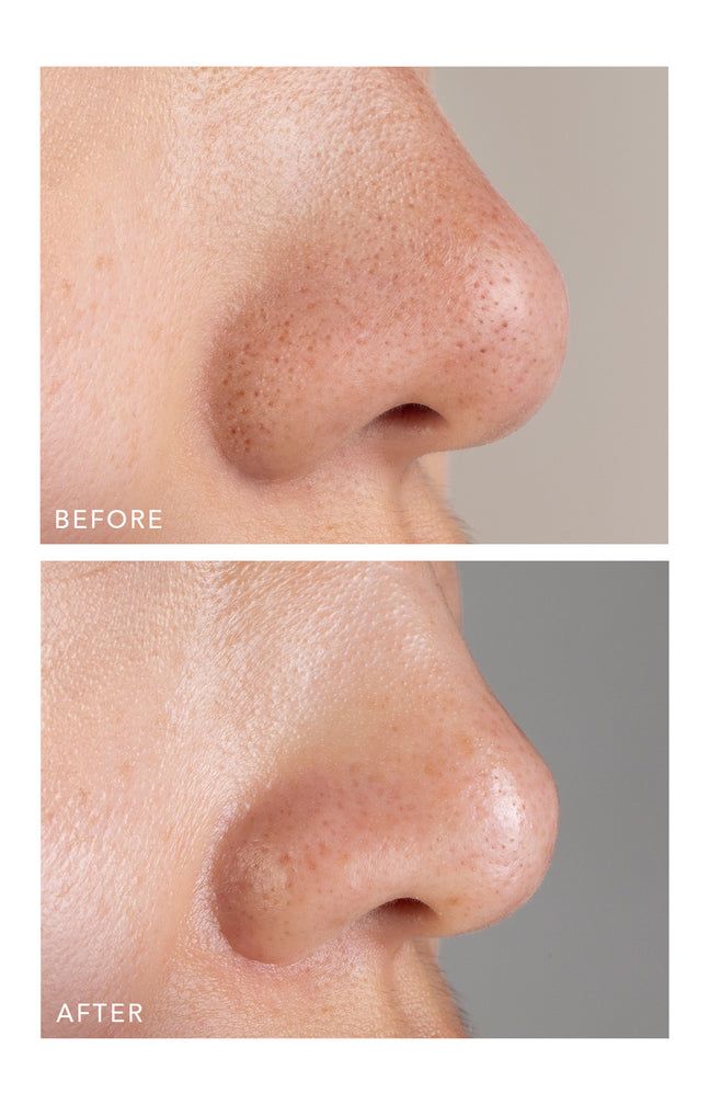KIWI™ masque purifiant - Anti-pores & points noirs - Visage