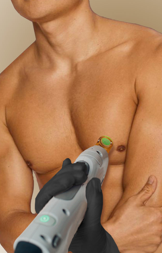Epilation laser Torse 3 séances - Homme